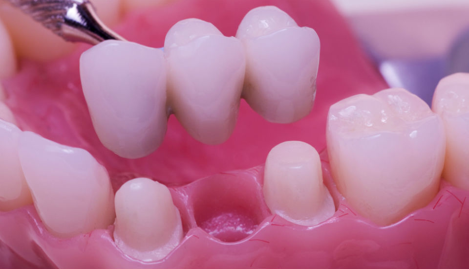 Zubni most može se fiksirati na izbrušene zube.