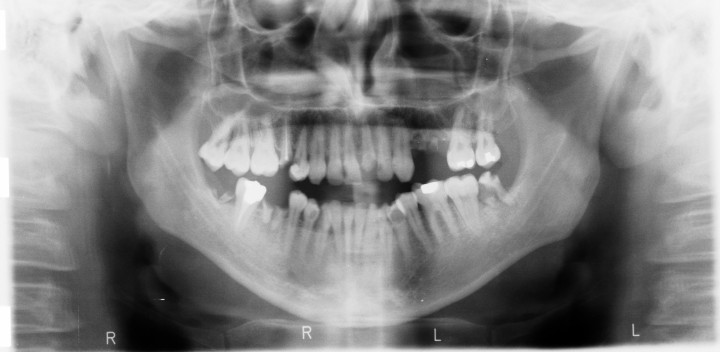 Pozicija zuba provjerava se pomoću rendgenskih snimki.