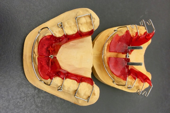 Mobilni aparatić oblikuje se prema modelu zubala