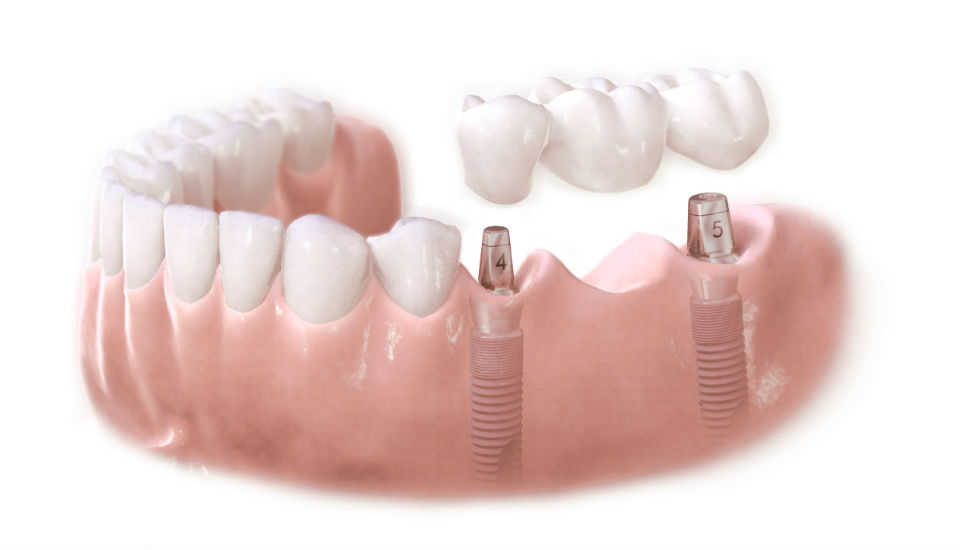 Postavljanje zubnog mosta na implantate